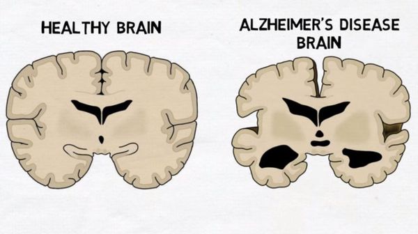 Мозг в норме и при болезни Альцгеймера