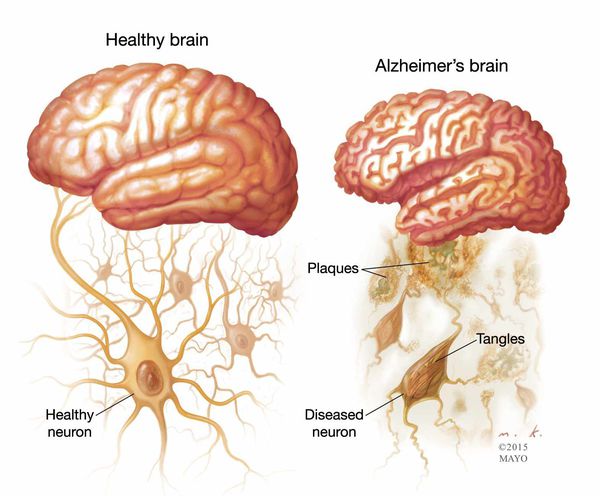 Мозг и нейроны в норме и при болезни Альцгеймера