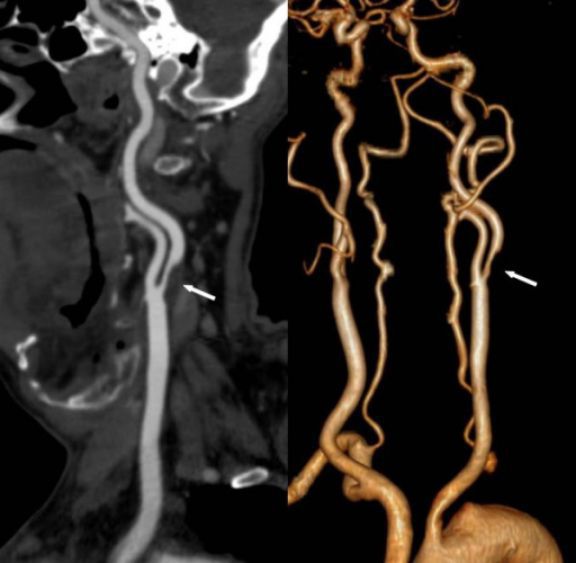 КТ-ангиография артерий шеи. Справа – двухмерное, слева – трехмерное изображение. Стрелки указывают на стеноз левой внутренней сонной артерии