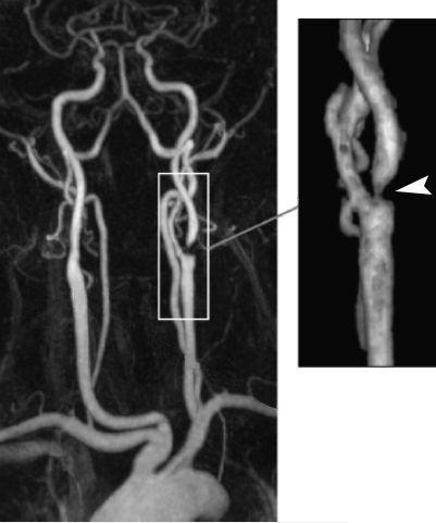 МР-ангиография артерий шеи с внутривенным контрастированием. Справа – увеличенное изображение бифуркации сонной артерии. Стрелка указывает на стеноз левой внутренней сонной артерии