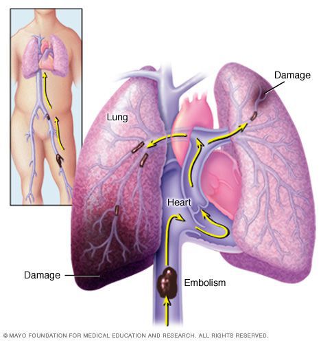 Тромбоэмболии лёгочной артерии