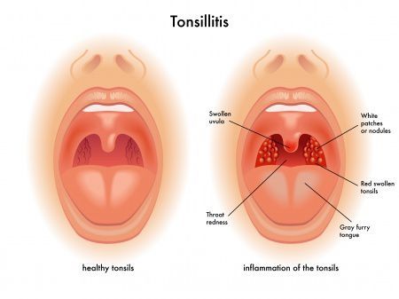 Здоровые миндалины и миндалины при тонзиллите