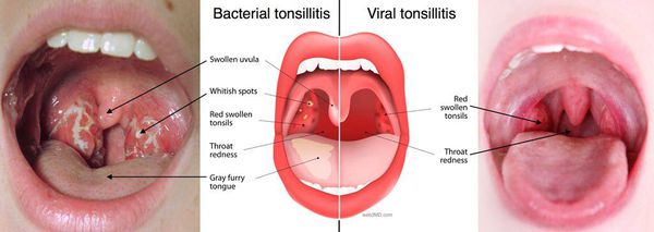 Бактериальный и вирусный тонзиллит