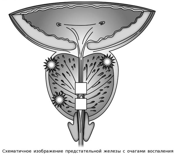 Схематичное изображение предстательной железы с очагами воспаления