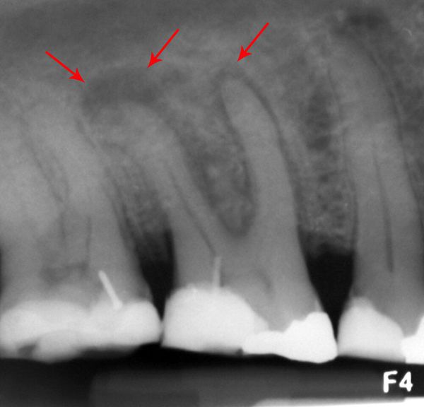 Абсцесс зуба на рентгеновском снимке