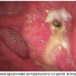 https://dgp1nn.ru/blog/wp-content/uploads/adenokarcinoma-zheludka-s.jpg