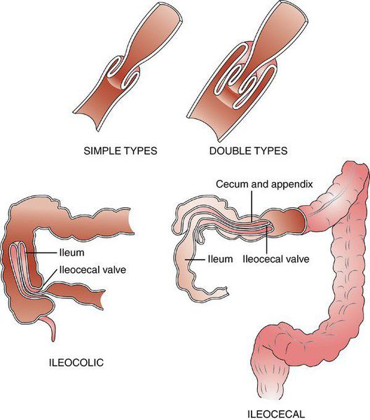 Анатомическая классификация инвагинации кишечника