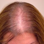https://dgp1nn.ru/blog/wp-content/uploads/androgeneticheskaya-alopeciya-s.jpg