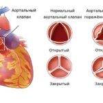 https://dgp1nn.ru/blog/wp-content/uploads/aortalnyy-klapan-v-norme-i-pri-stenoze-s.jpg