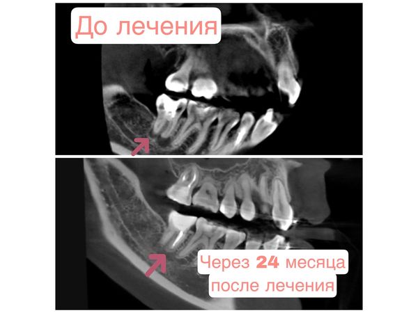 Апикальный периодонтит: случай успешного лечения правого нижнего моляра