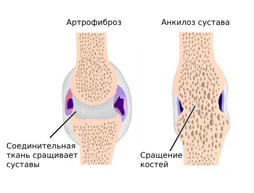 Артрофиброз и анкилоз сустава
