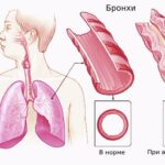 https://dgp1nn.ru/blog/wp-content/uploads/astmaticheskiy-bronhit-s.jpeg