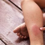Атопический дерматит у детей: причины, симптомы и лечение