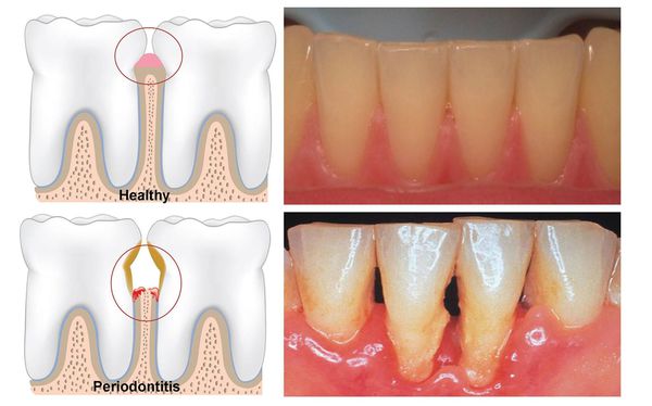 Атрофия тканей, удерживающих зуб