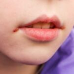Белое пятно на губе: причины и лечение - полезная информация