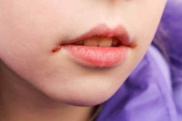 Белое пятно на губе: причины и лечение