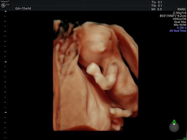 Малыш на УЗИ 4D (стоп-кадр)