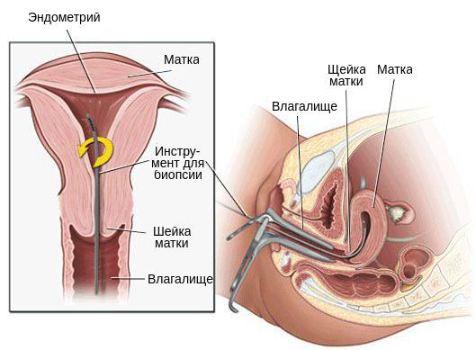 Биопсия внутреннего слоя матки