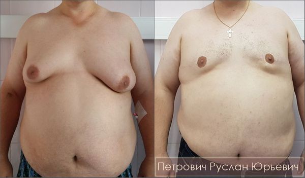 Боковая подтяжка груди при асимметричной гинекомастии IV стадии — результат операции через год