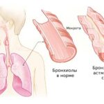https://dgp1nn.ru/blog/wp-content/uploads/bronhioly-pri-astmaticheskom-statuse-s-7syzxls.jpeg