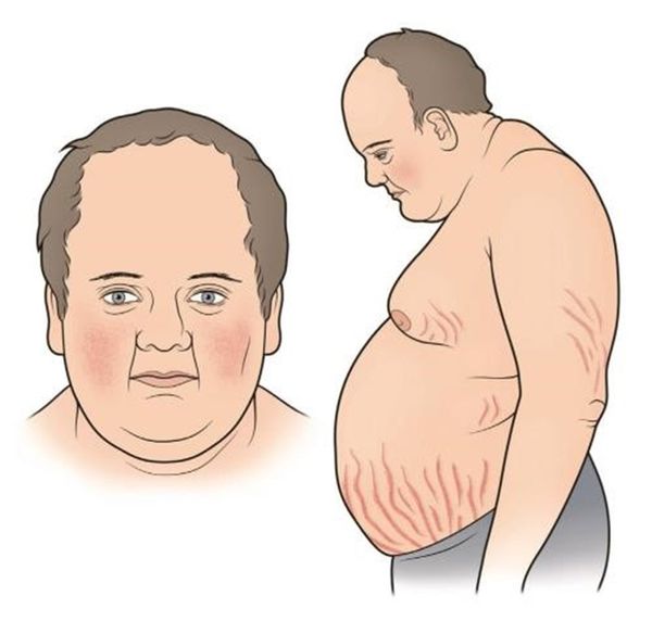 Центральные жировые отложения при синдроме Кушинга