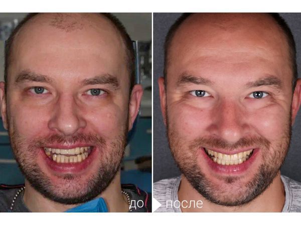До и после лечения