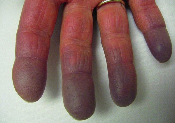Цианоз пальцев при синдроме Рейно 