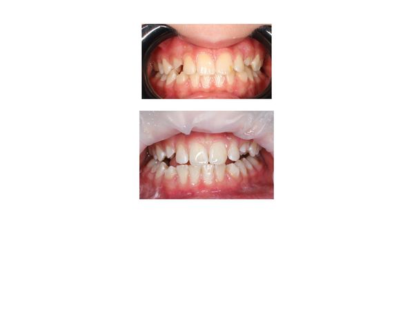 До и после лечения травмы зуба 21 