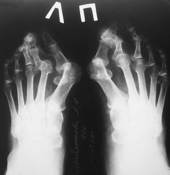Деформирующий артроз плюсне-фаланговых суставов, рентгенография
