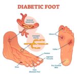 https://dgp1nn.ru/blog/wp-content/uploads/diabeticheskaja-stopa-simptomy-i-lechenie_1.jpg