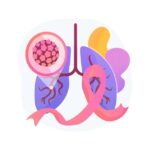 Диагноз рак легких: прогноз выживаемости и продолжительность жизни