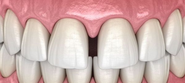 Диастема (щель) между зубами