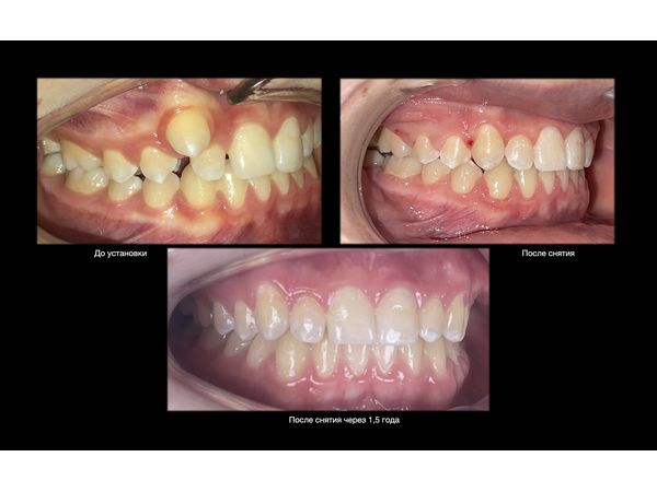 Дистопия клыка: случай успешного лечения с помощью брекет-системы