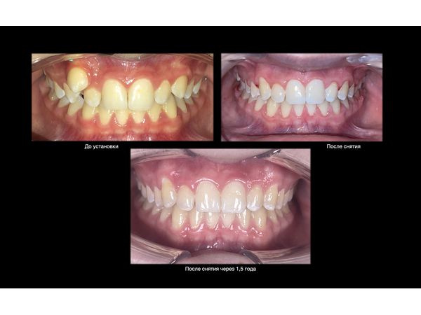Результат лечения: центральные зубы