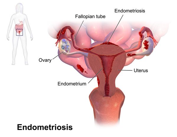 Возможные очаги эндометриоза