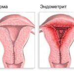 https://dgp1nn.ru/blog/wp-content/uploads/endometrit-i-norma-s.jpg