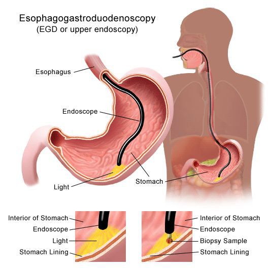 Эндоскопическое обследование желудка