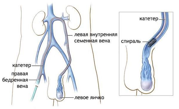 Эндоваскулярная окклюзия яичковой вены