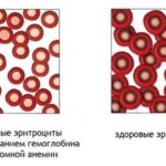 https://dgp1nn.ru/blog/wp-content/uploads/eritrocity-v-norme-i-pri-gipohromnoy-anemii-s.jpeg