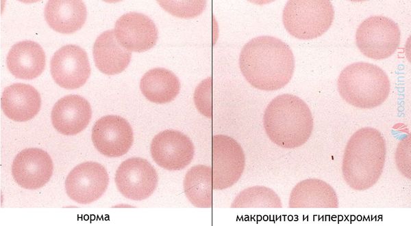 Эритроциты в норме и при макроцитарной гиперхромной анемии