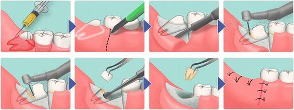 Этапы удаления дистопированного зуба