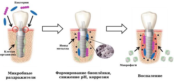 Формирование биоплёнки на имплантате 