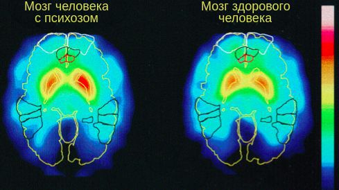 Функционирование мозга человека с острым психозом