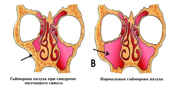 Гайморова пазуха при синдроме молчащего синуса и в норме 