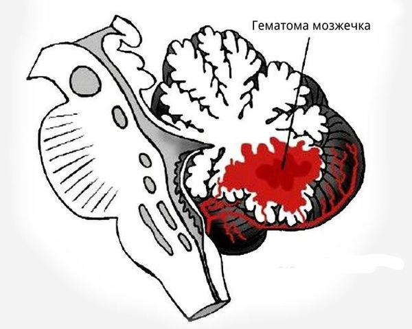 Гематома мозжечка