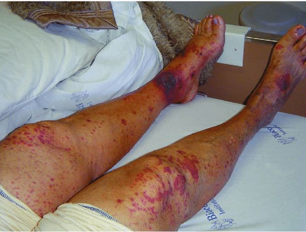 Геморрагическая сыпь и участки отмирания кожи 