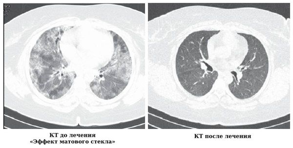 Гемосидероз лёгких на КТ 