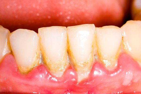 Гингивит осложнение зубного камня