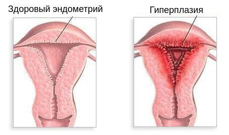 Гиперплазия внутреннего слоя матки