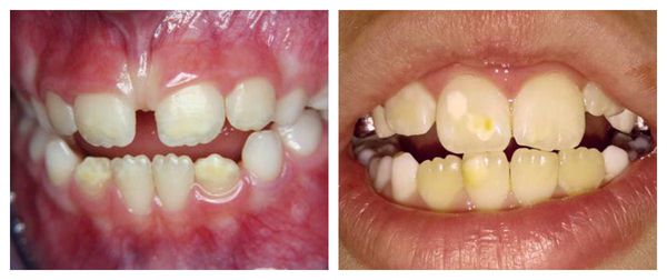 Гипоплазия передних зубов